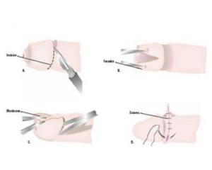 传统手工切包皮,包皮手术手工切割好还是机器好