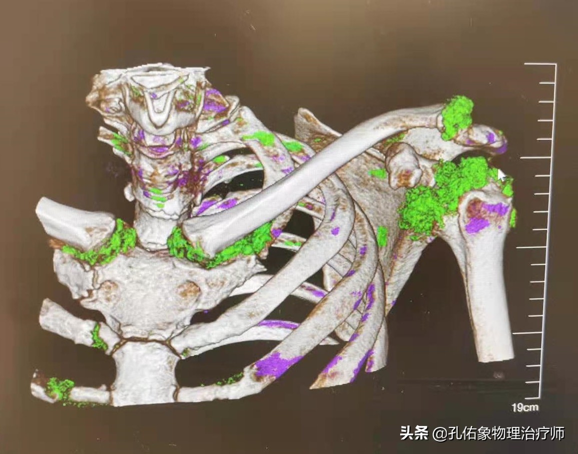 肩膀疼痛一般是什么原因引起的,肩膀疼跟哪些病因有关系