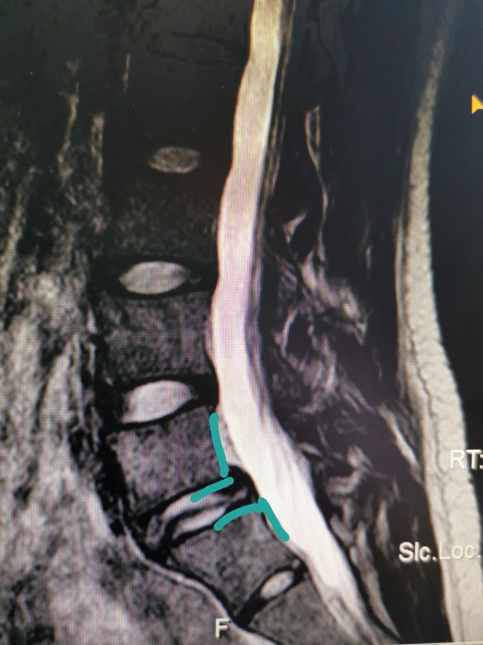 腰椎滑脱的治疗方法,腰椎滑脱手术医保多少钱