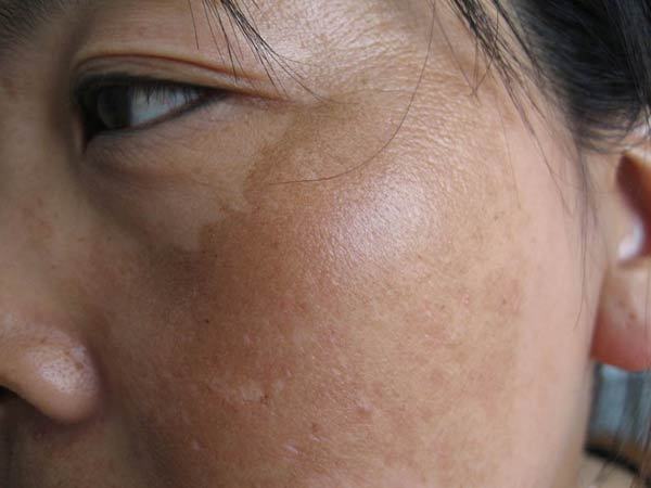 褐斑可以通过内调去掉吗,褐青色斑一个月去一次会怎样