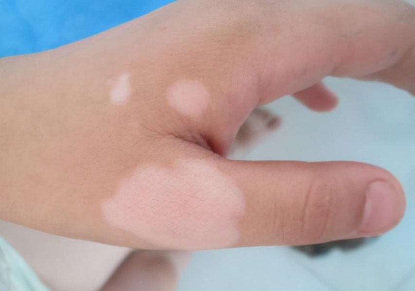 白癜风的常见治疗误区都有哪些,得了白癜风一定要注意这2点