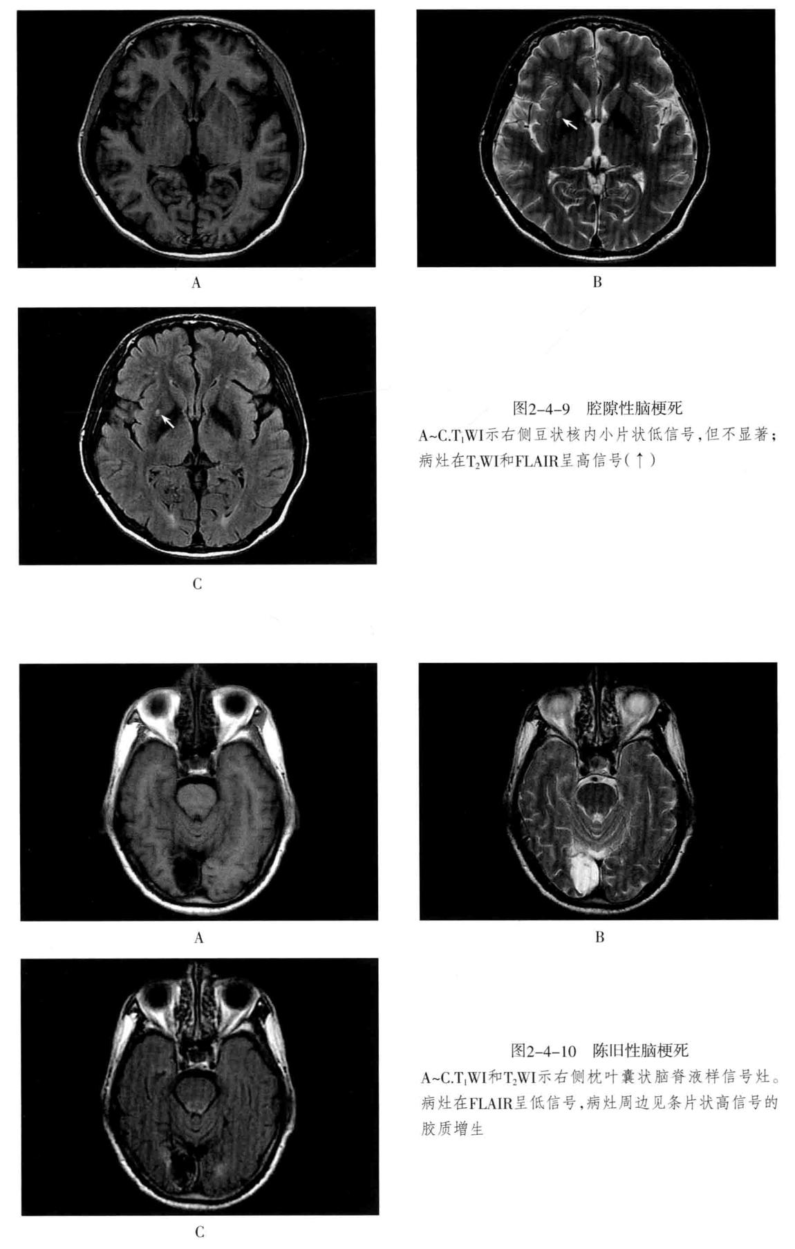 颅内血管轻度狭窄诊断标准,颅内血管先天变异影像