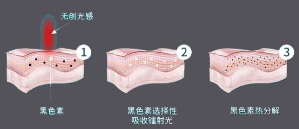 无创洗眉有市场吗,加盟无创洗眉