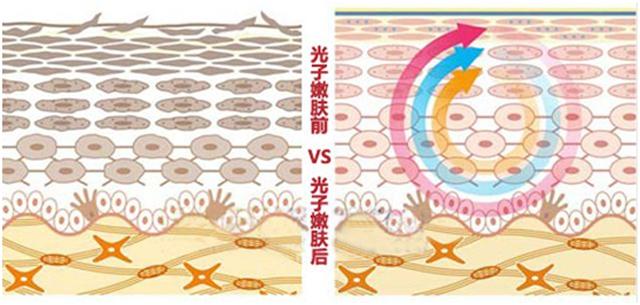 光子嫩肤几岁开始打比较好,光子嫩肤需要一直做一辈子吗