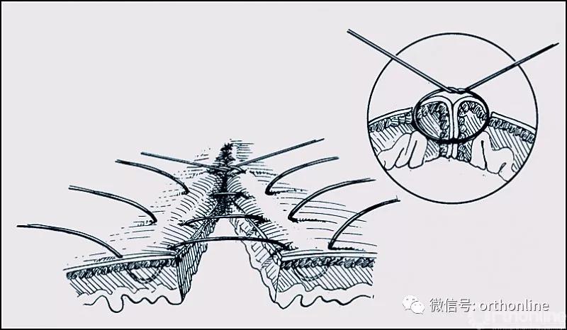 常用的手术缝合方法图,临床常见常用伤口缝合方法