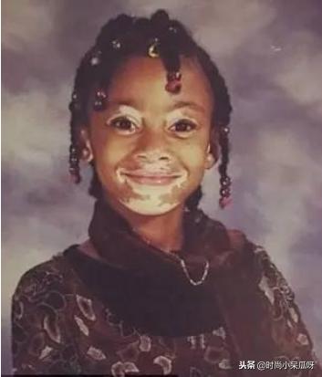 患白癜风的超模,有白癜风的国际名模