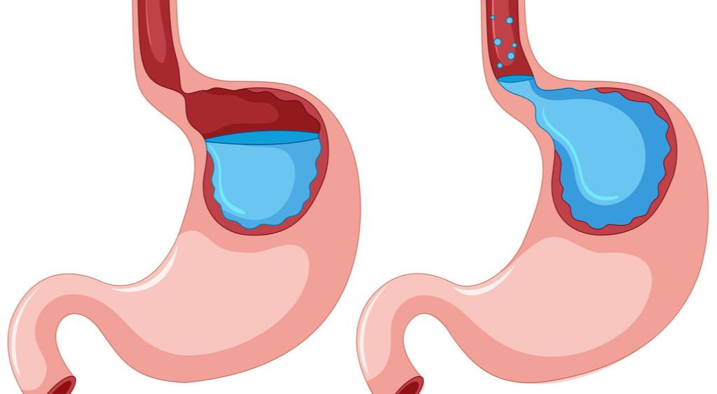 胃食管结合部腺癌预后怎样,食管胃结合部癌的外科治疗策略