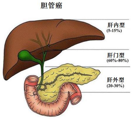肝移植患者得了胆管癌,亲人得了胆管癌该怎么办