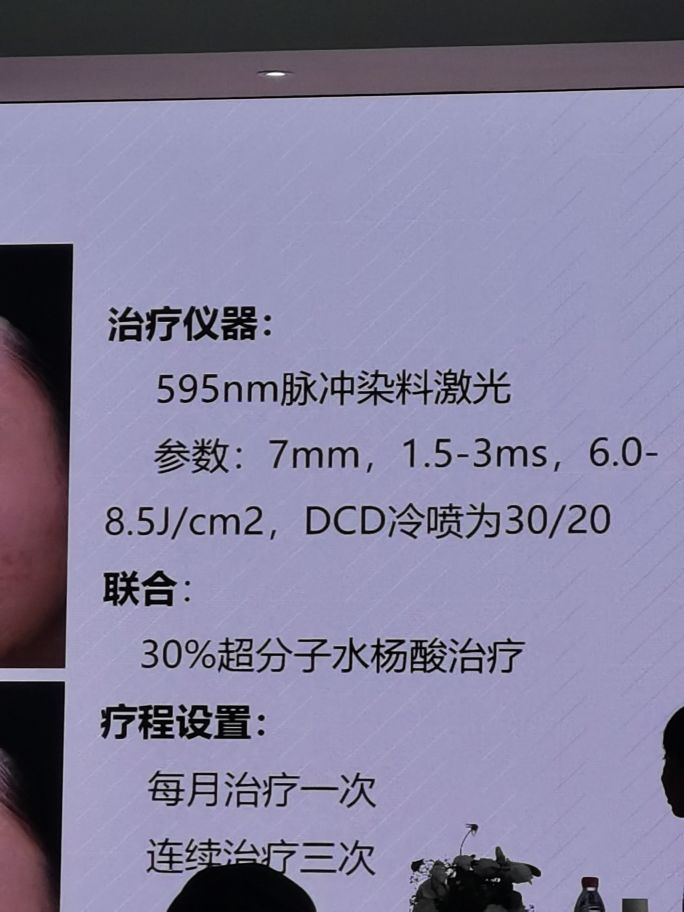 冷冻祛痣和脉冲染料激光,脉冲染料激光祛鲜红斑痣后有红印