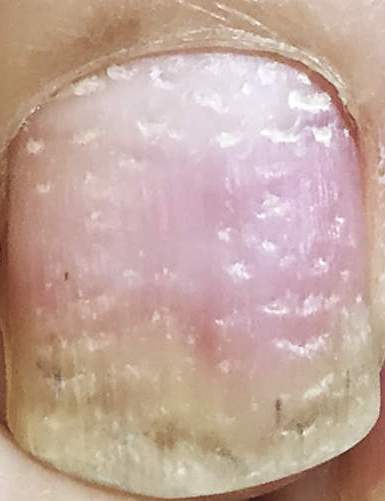 银屑病关节炎炎症怎么消除,银屑病关节炎扶他林乳膏