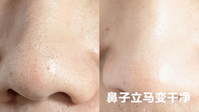 如何从根本上解决黑头问题,黑头太顽固教你去黑头的方法