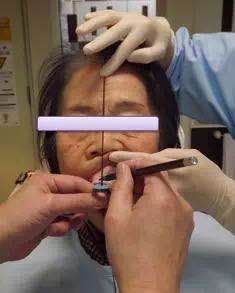 咬合重建的程序,咬合重建做嵌体