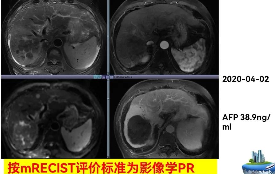 肝癌晚期靶向治疗怎么做,中国肝癌tace治疗展望