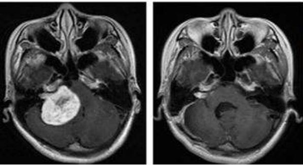 一表总览！迄今为止最全的肿瘤质子治疗适应症盘点！（收藏备用）