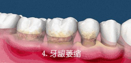 洗牙会不会使牙缝变大呢,洗牙会使牙齿松动牙缝变大吗