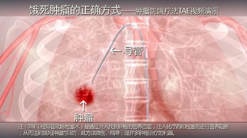 肿瘤饥饿疗法趣味视频,肿瘤饥饿疗法的优缺点