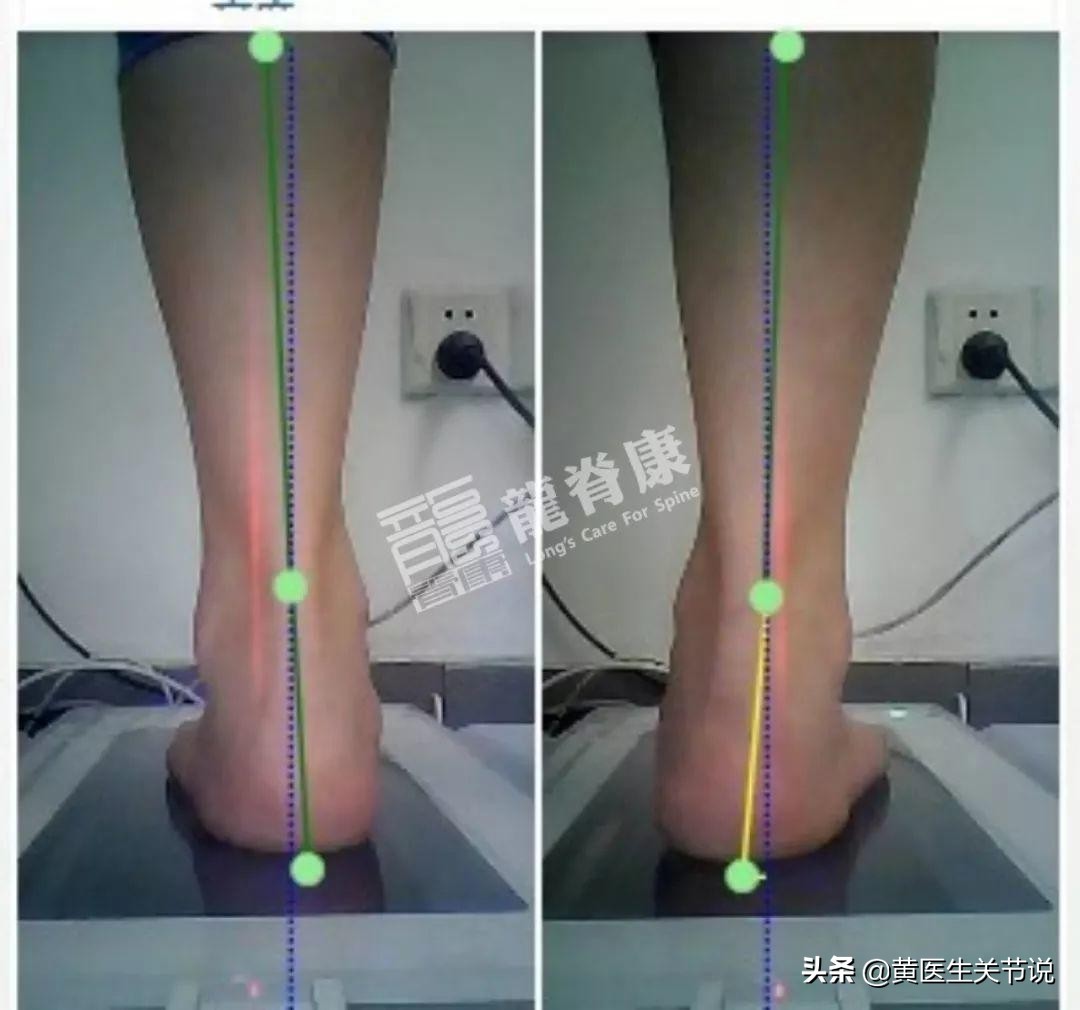 右足趾痛症是怎么引起的,第二足趾关节疼痛