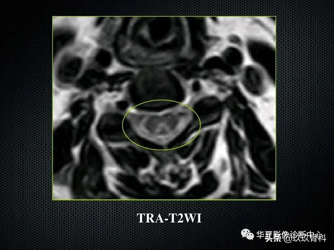 颈椎病脊髓变性mri表现,脊髓亚急性联合变性的诊断