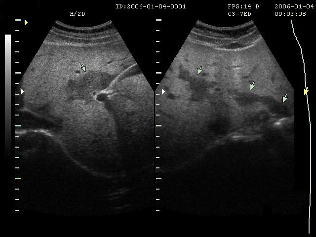 慢性肝病做肝功能检查出来吗,检查肝炎抽血化验要空腹吗