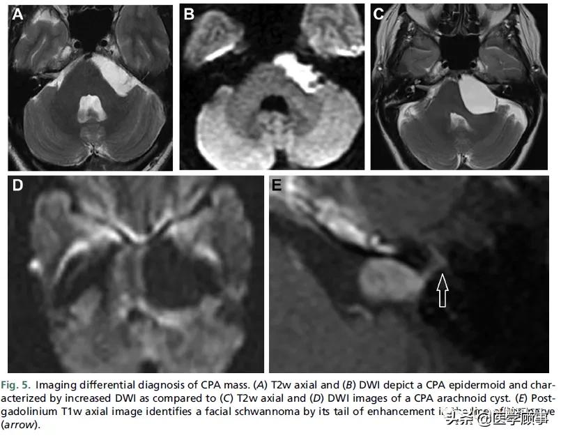 「综述」前庭神经鞘瘤的成像：诊断、监测、和治疗计划