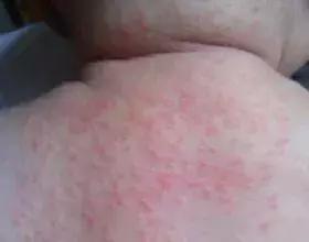 痱子粉止痒儿童,孩子起痱子用痱子粉管用吗