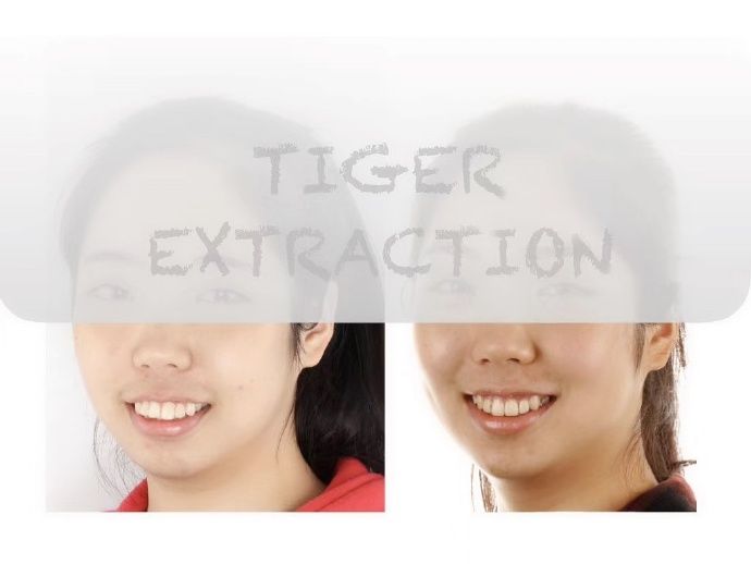 牙齿矫正南京哪家医院比较好,牙齿代偿性矫正