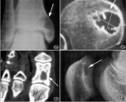 手腕出现小疙瘩越来越大,手腕突然长了一个小骨