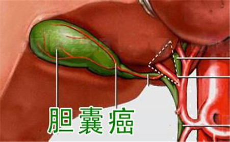 胆囊结石切除后影响寿命,胆囊切除对人寿命影响吗