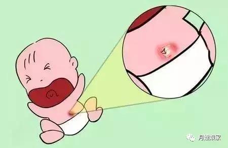 小孩长黄疸月嫂有责任吗,新生儿败血症和月嫂照顾有关