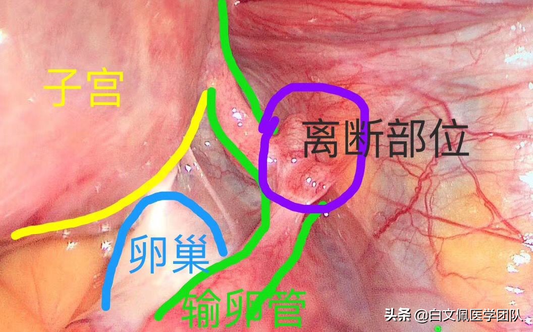 腹腔镜妇科解剖教学视频教程,白文佩医学团队