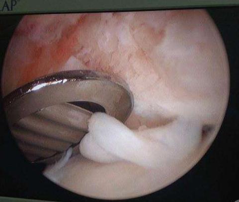 骨刺和骨质增生怎么治疗好得快,骨刺和骨质增生能吃骨刺平吗