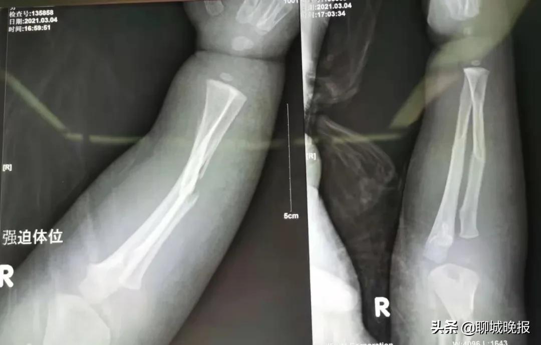 一岁多的聊城娃,牵动多地名医心