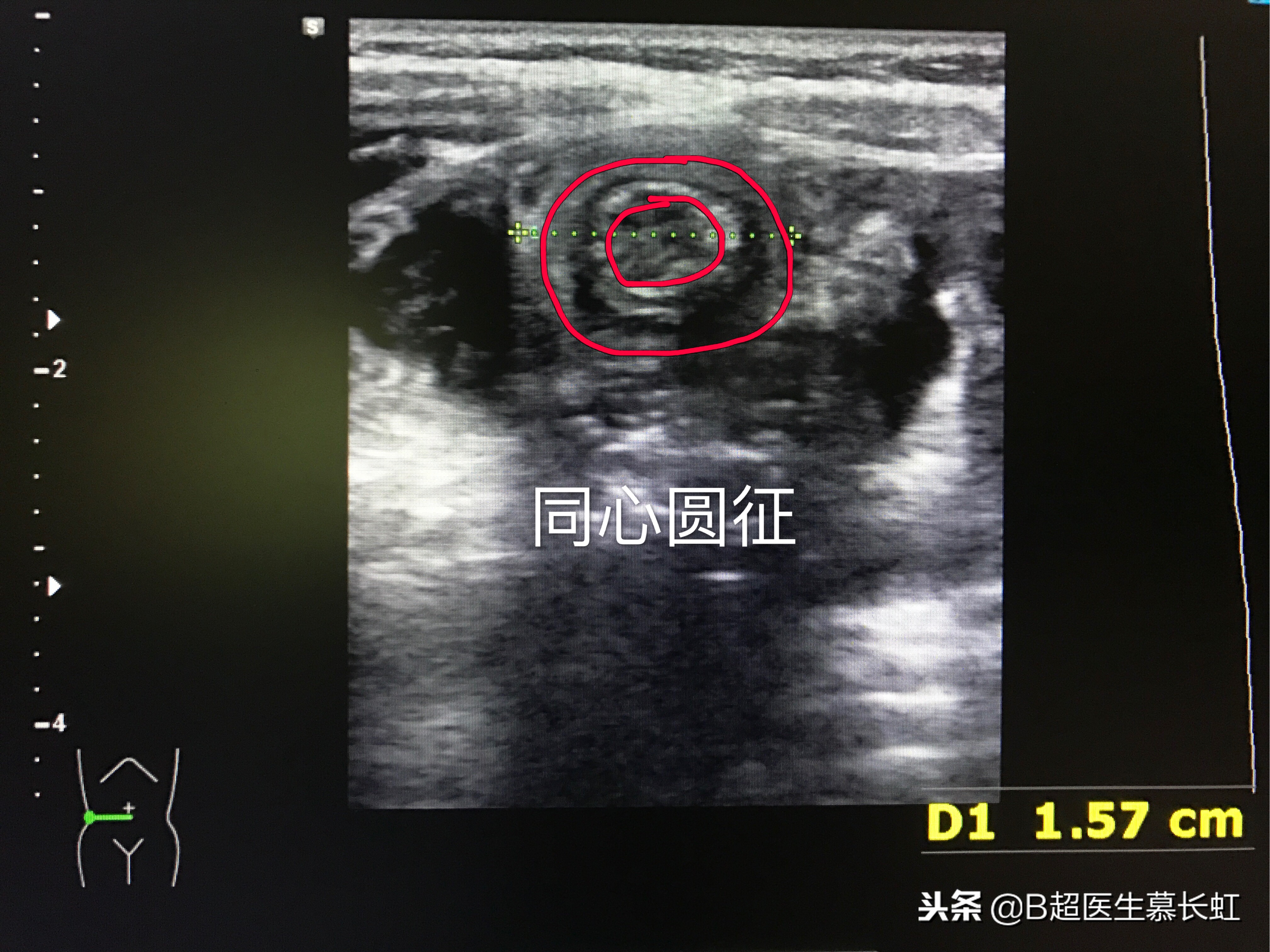 儿童肚子疼呕吐拉血怎么回事,2岁宝宝说肚子痛肠套叠