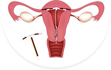 上环后月经会提前或者延后吗,上环后月经推迟一周会不会怀孕