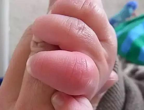 民间治冻疮的最好方法,老中医妙方萝卜加陈皮治冻疮