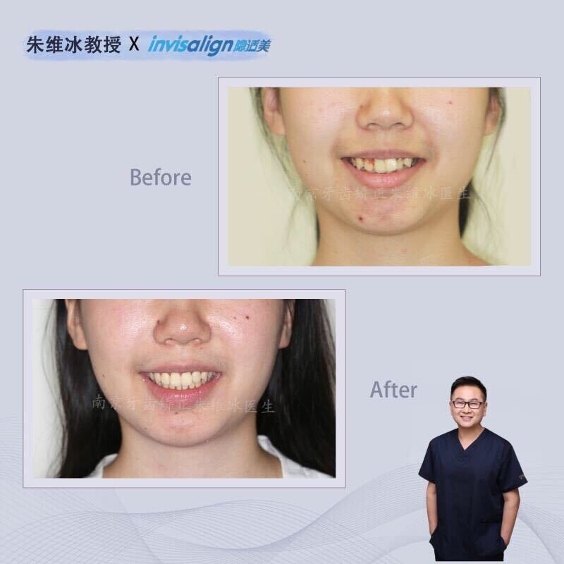 隐适美牙齿拥挤矫正真实案例,南京朱维冰