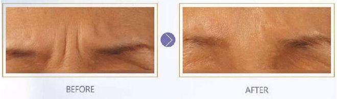 眉间纹怎么消除才最快最有效,消除眉间纹最有效的方法