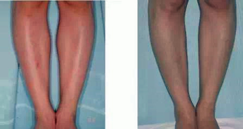 改善腿型的腿部动作,腿部线条不好看怎么练