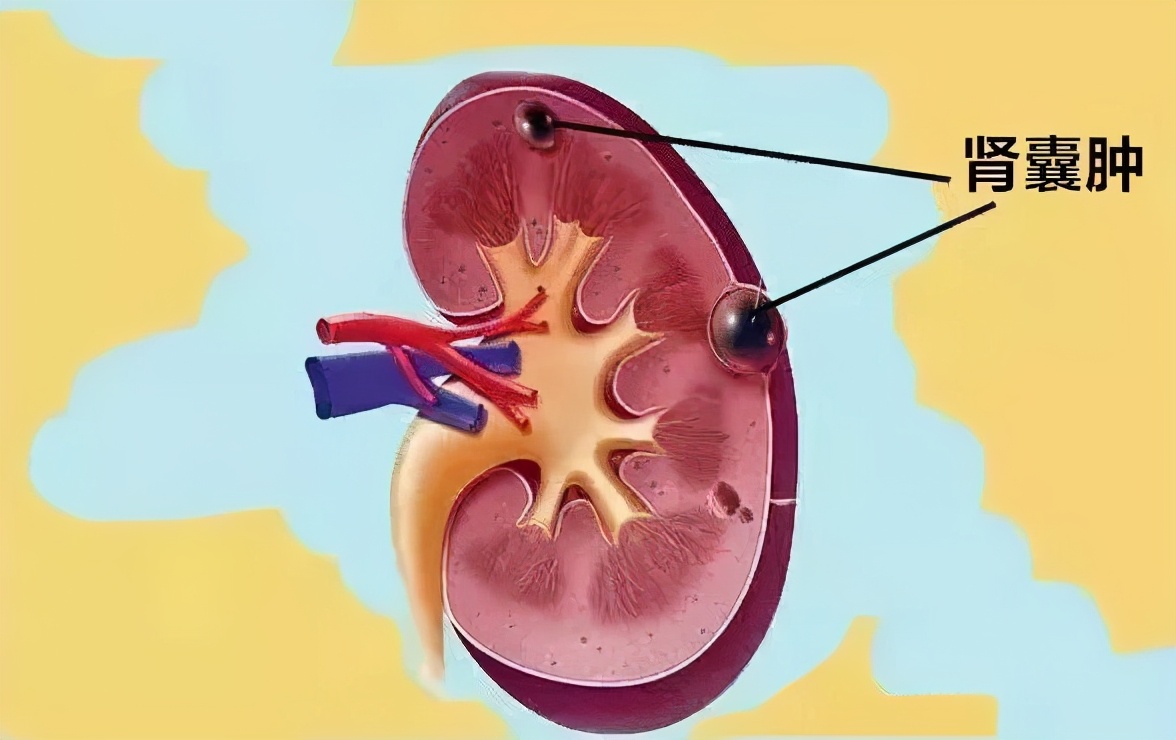 体检有肝囊肿需要治疗吗,体检发现肝囊肿我该怎么办