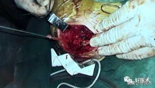 肩锁关节脱位手术后多久可以喝酒,肩锁关节脱位钢板内固定步骤记录