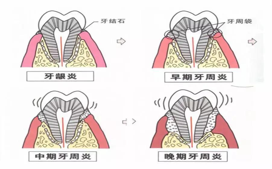 老年人牙疼最快止疼法,老年人牙疼是怎么回事