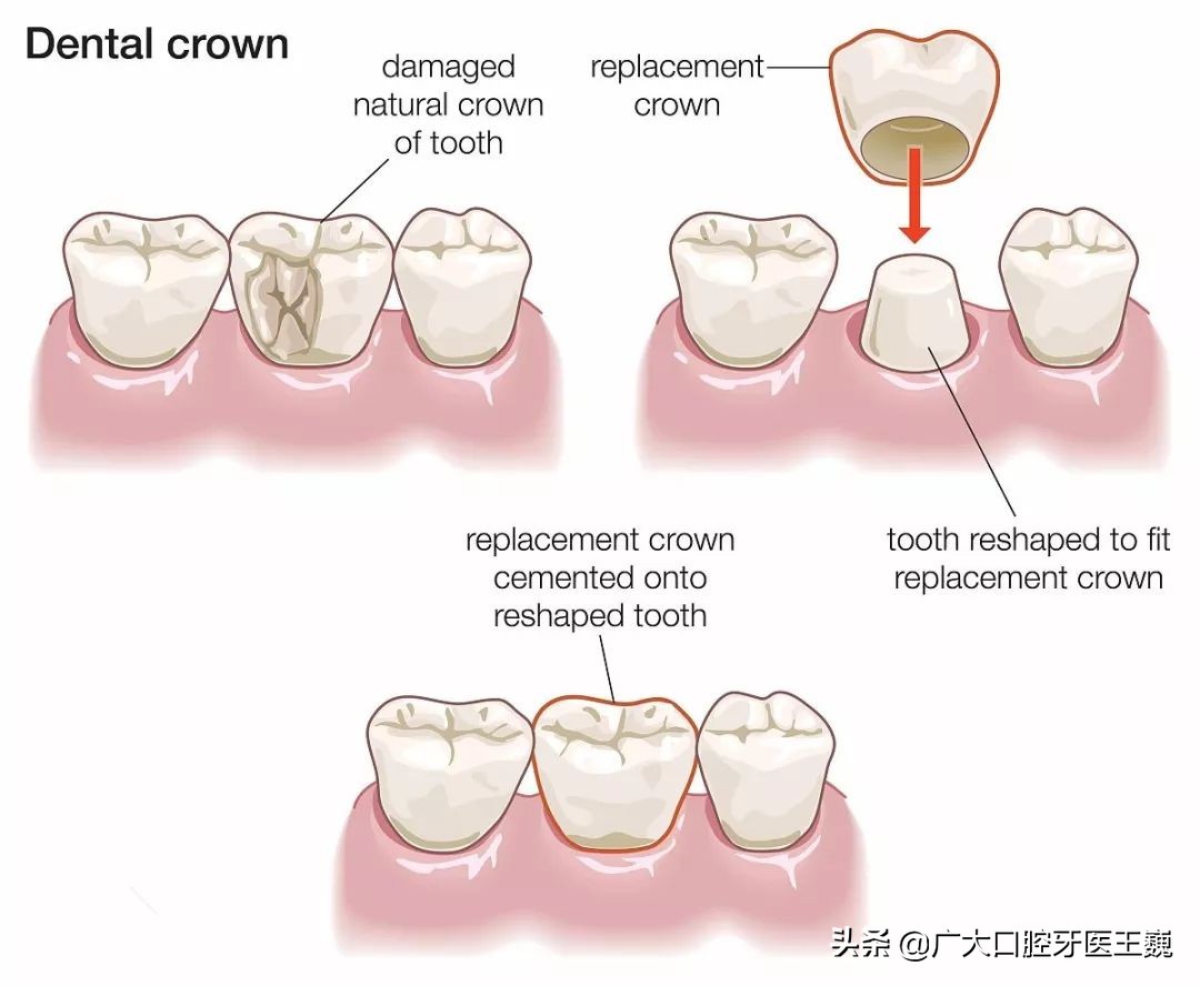 全瓷牙和烤瓷牙有什么区别哪个好,烤瓷牙和全瓷牙有什么区别怎么选