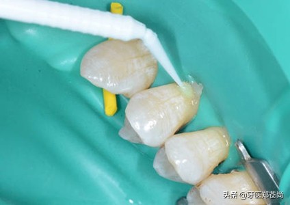 牙齿楔形磨损能修复吗,牙齿楔形损伤是什么意思