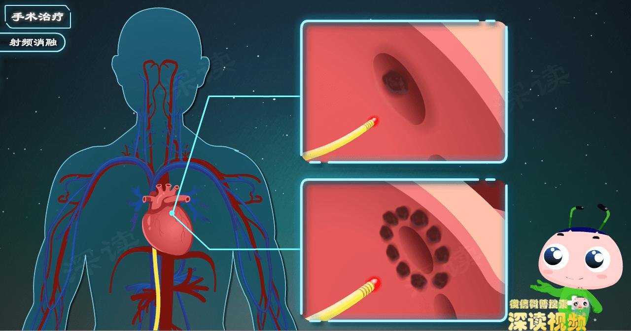 房颤射频消融术与心脏搭桥与支架,房颤选择迷宫术还是射频消融术