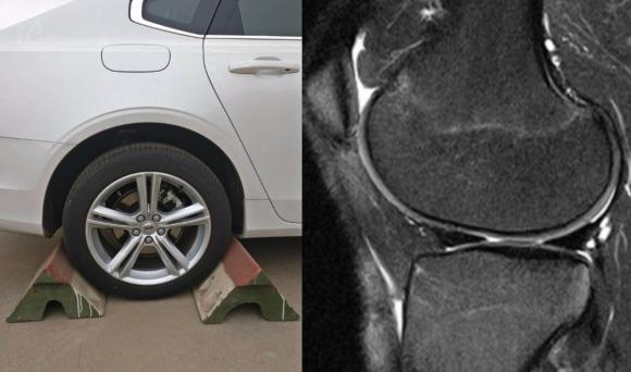 半月板损伤康复训练,半月板损伤膝盖疼的最好治疗方法