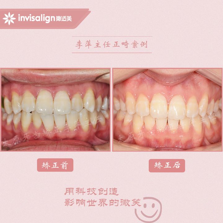 太原矫正牙齿需要做正颌吗,太原牙齿二次矫正