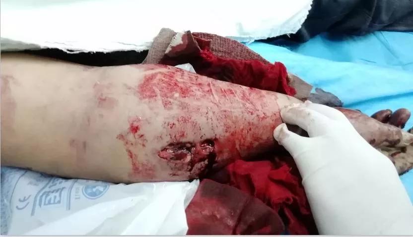 家人用皮筋包扎伤口结果导致截肢,截肢患者弹力绷带包扎法