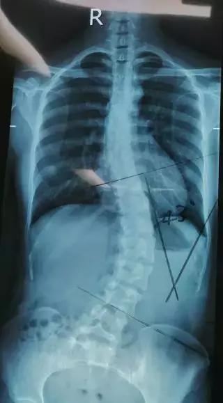 什么动作可以把背撑直,挺不直背怎么办