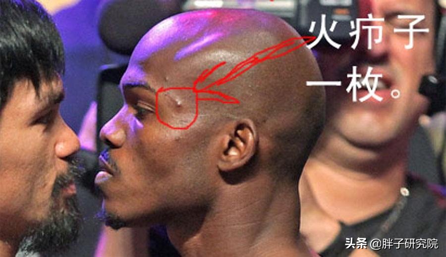 谈谈火“疖”子：毛囊炎的发病及日常护理