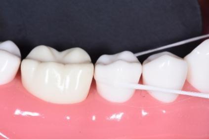 牙周病真实事件,牙周病危害大吗